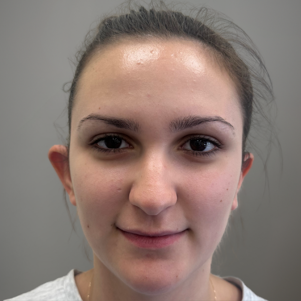 Пациент преди отопластика – фронтален изглед, видимо изразено отстояние на ушите