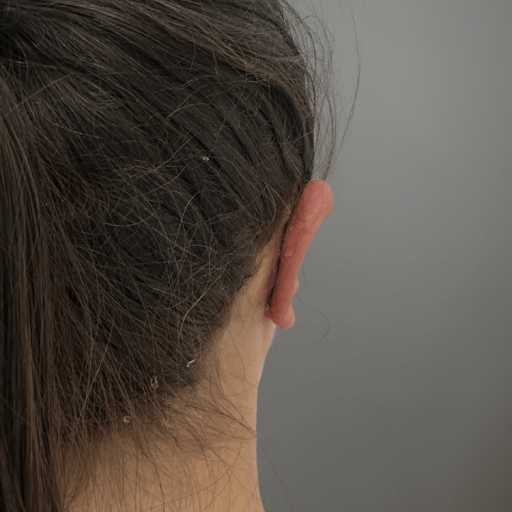 Заден изглед на дясно ухо след отопластика, с естествена позиция и хармоничен профил спрямо главата.