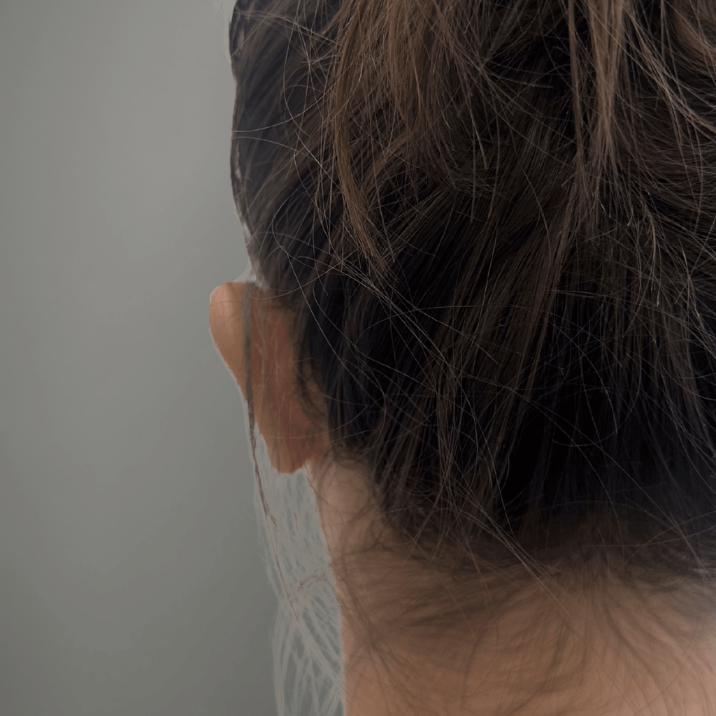 Случай на отопластика – изглед след операцията, приближено ухо и гладка кожа зад ухото