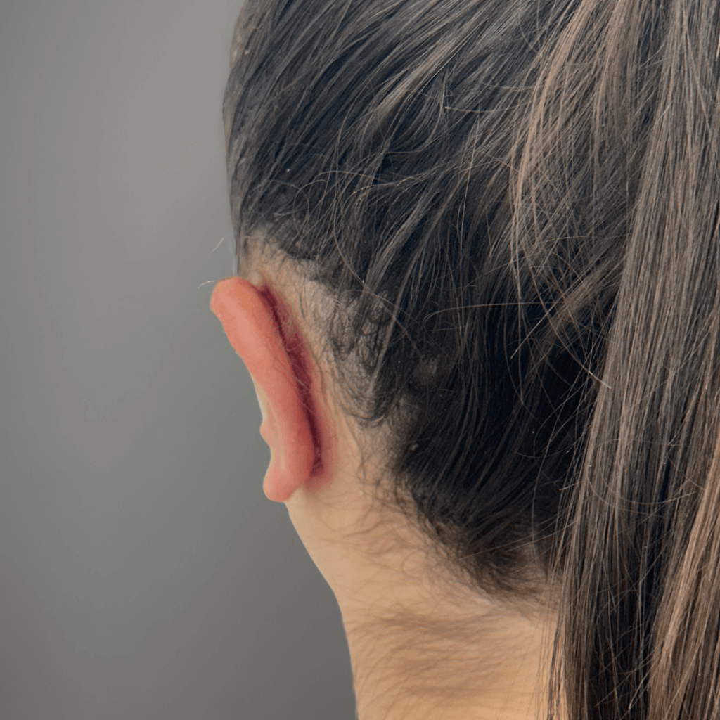 Случай на отопластика – изглед след операцията с дискретен белег зад ухото