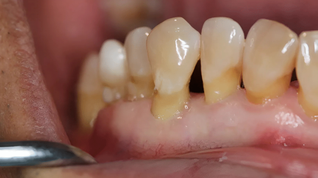 Пародонтален проблем с открити зъбни шийки и натрупване на зъбен камък – напреднал гингивит или пародонтит