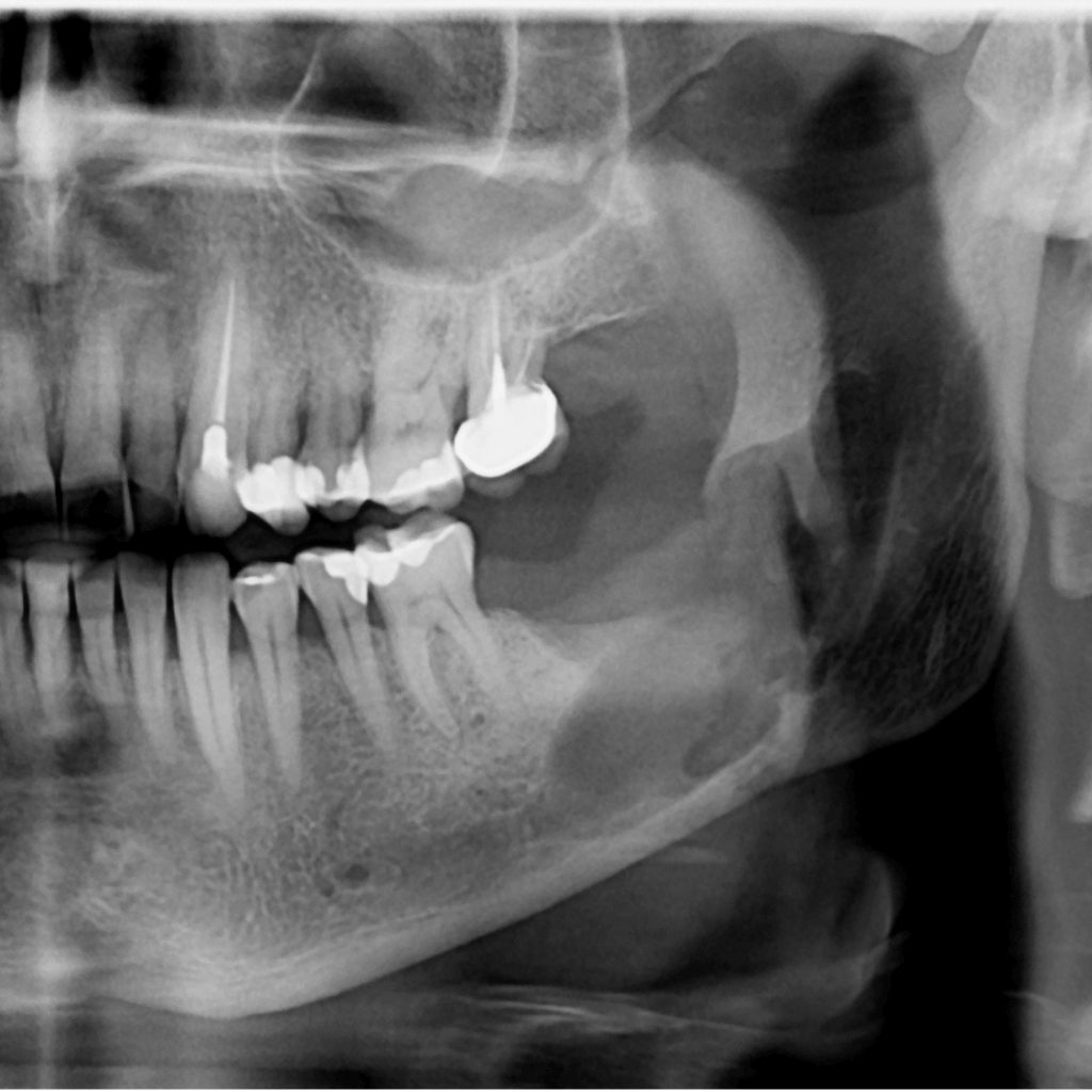 Рентгенова снимка преди поставяне на дентален имплант, показваща липсващ зъб в долната челюст и състоянието на костта преди хирургичната интервенция в клиника Aesthetico