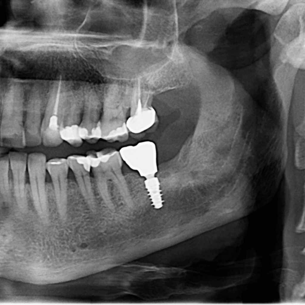 Панорамна рентгенография (ортопантомография) на зъбите и челюстите с поставен дентален имплант в долната челюст