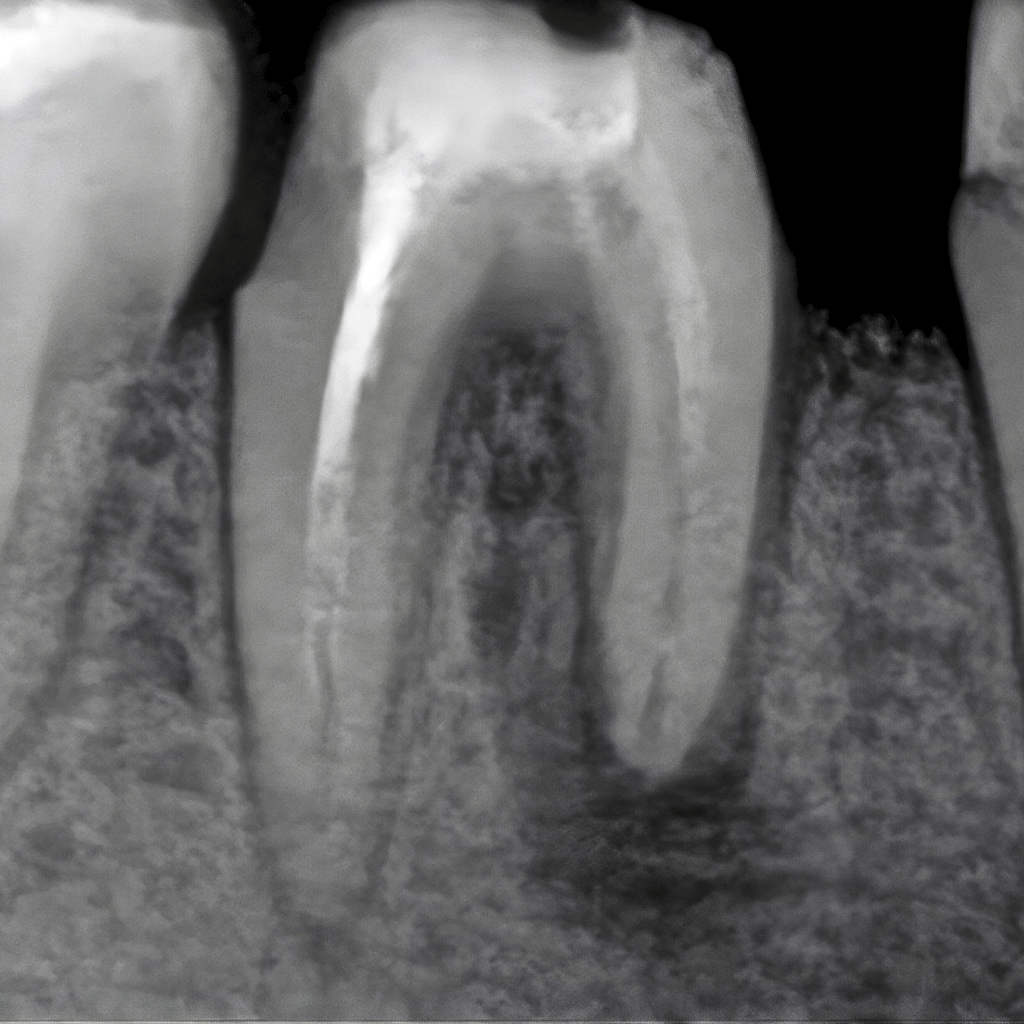 Дентална рентгенография преди ендодонтско лечение – зъб с незапълнени коренови канали и данни за възпалителни промени в периапикалната област.