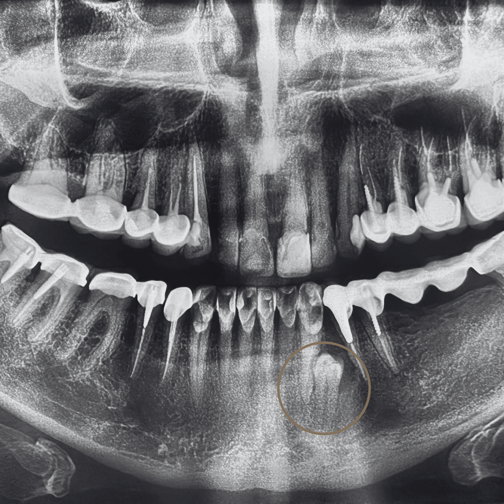 Панорамна рентгенография с наличие на ретиниран кучешки зъб в долната челюст, разположен дълбоко в костта и индикиран за хирургично отстраняване.