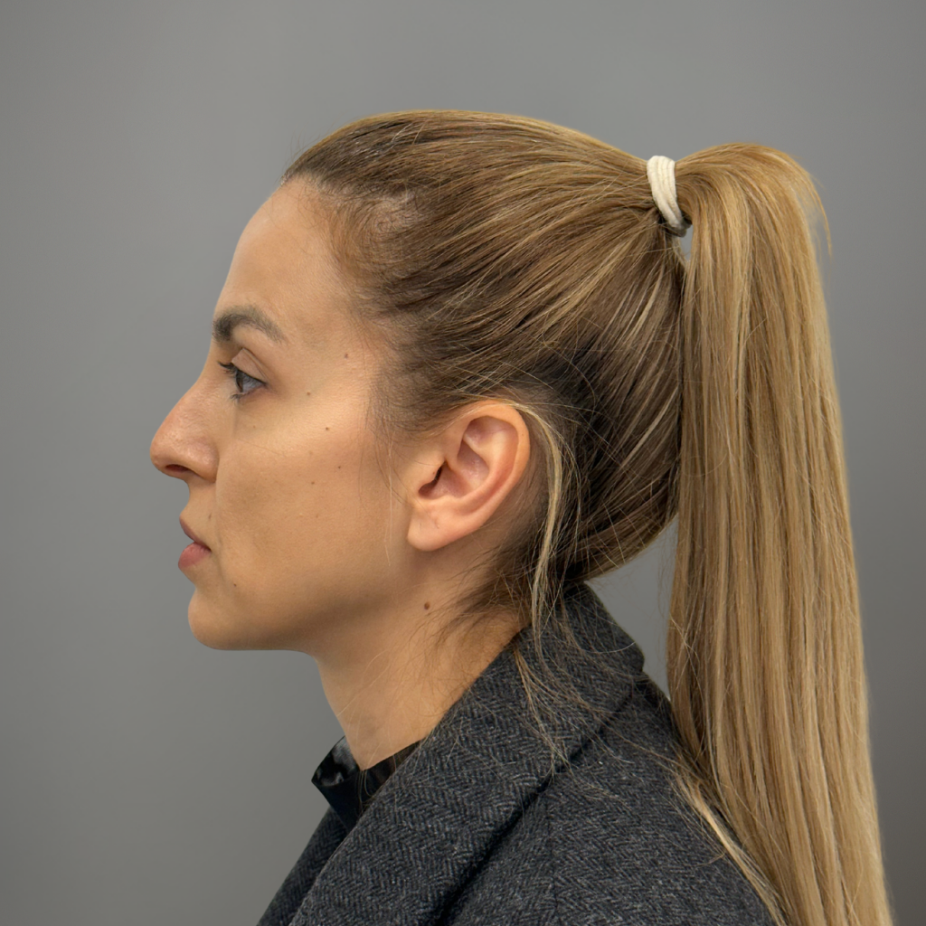 Профил на жена преди ринопластика – ясно видим гърбав профил на носа.