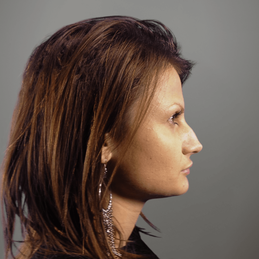 Профилен изглед на лице преди ринопластика, с подчертана форма на носа и изразен носен профил.