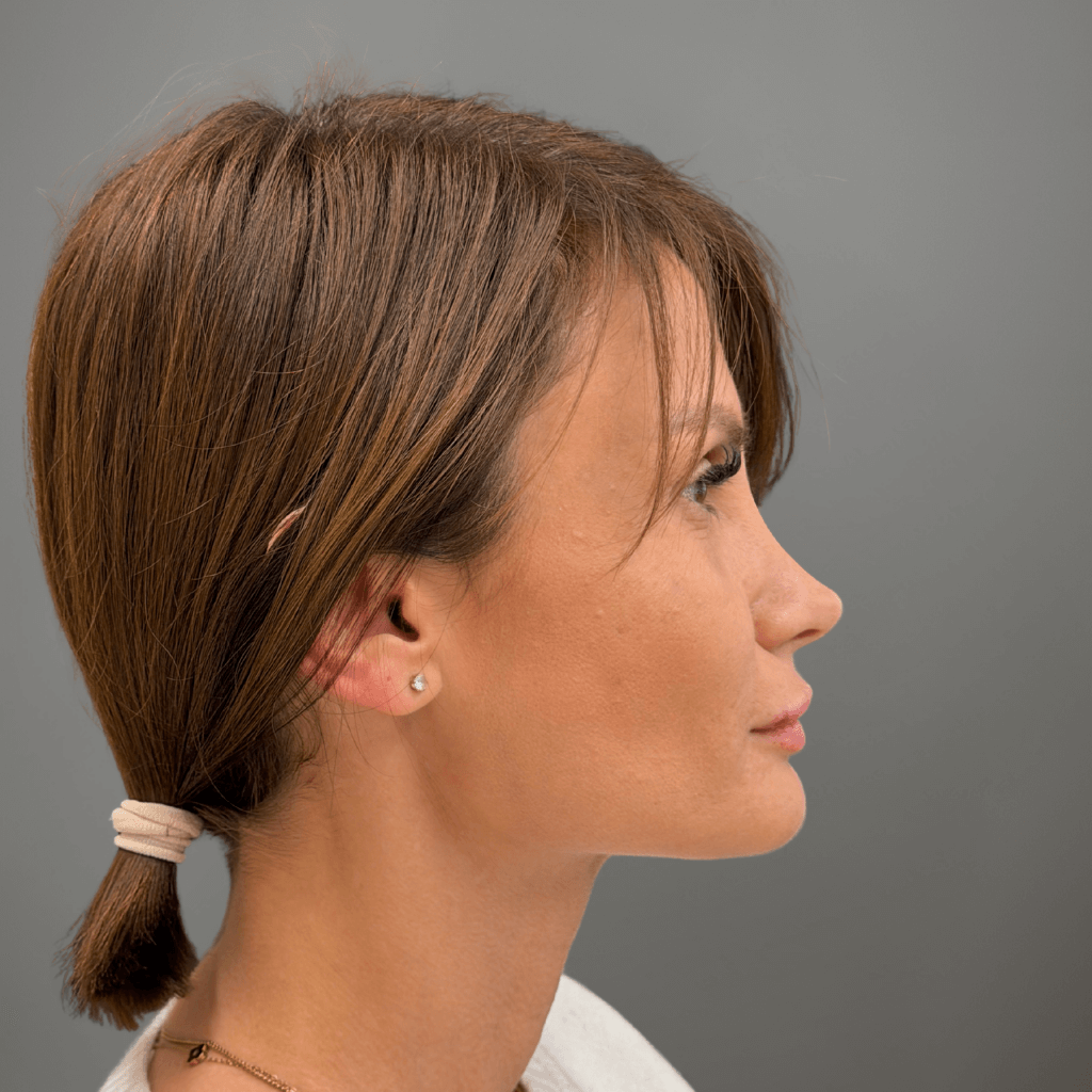 Профилен изглед на лице след ринопластика, с коригиран носен контур и по-хармонични лицеви пропорции.