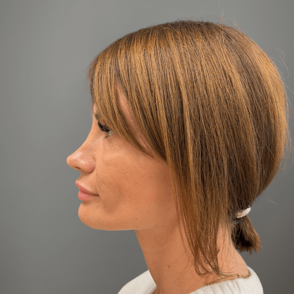 Профилен изглед на лице след ринопластика, с изгладена линия на носа и естествен профилен резултат.