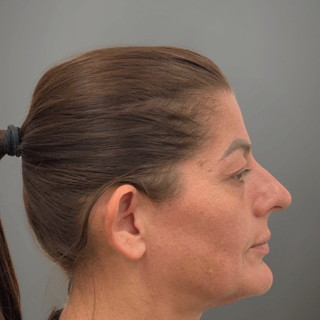 Профилен изглед на лице преди ринопластика, с изразен носен профил и подчертана форма на носа.