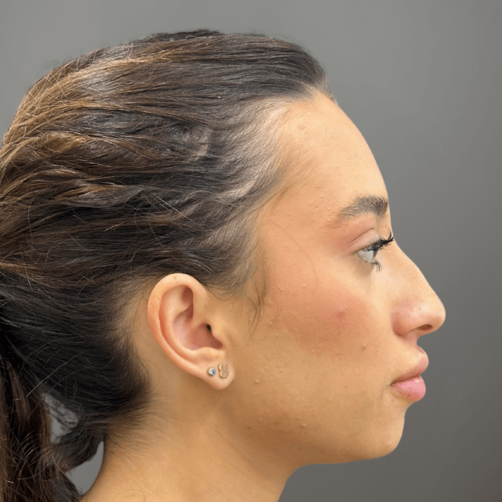 Профилен изглед на лице преди ринопластика, с изразен гръб на носа и нарушен профилен баланс.