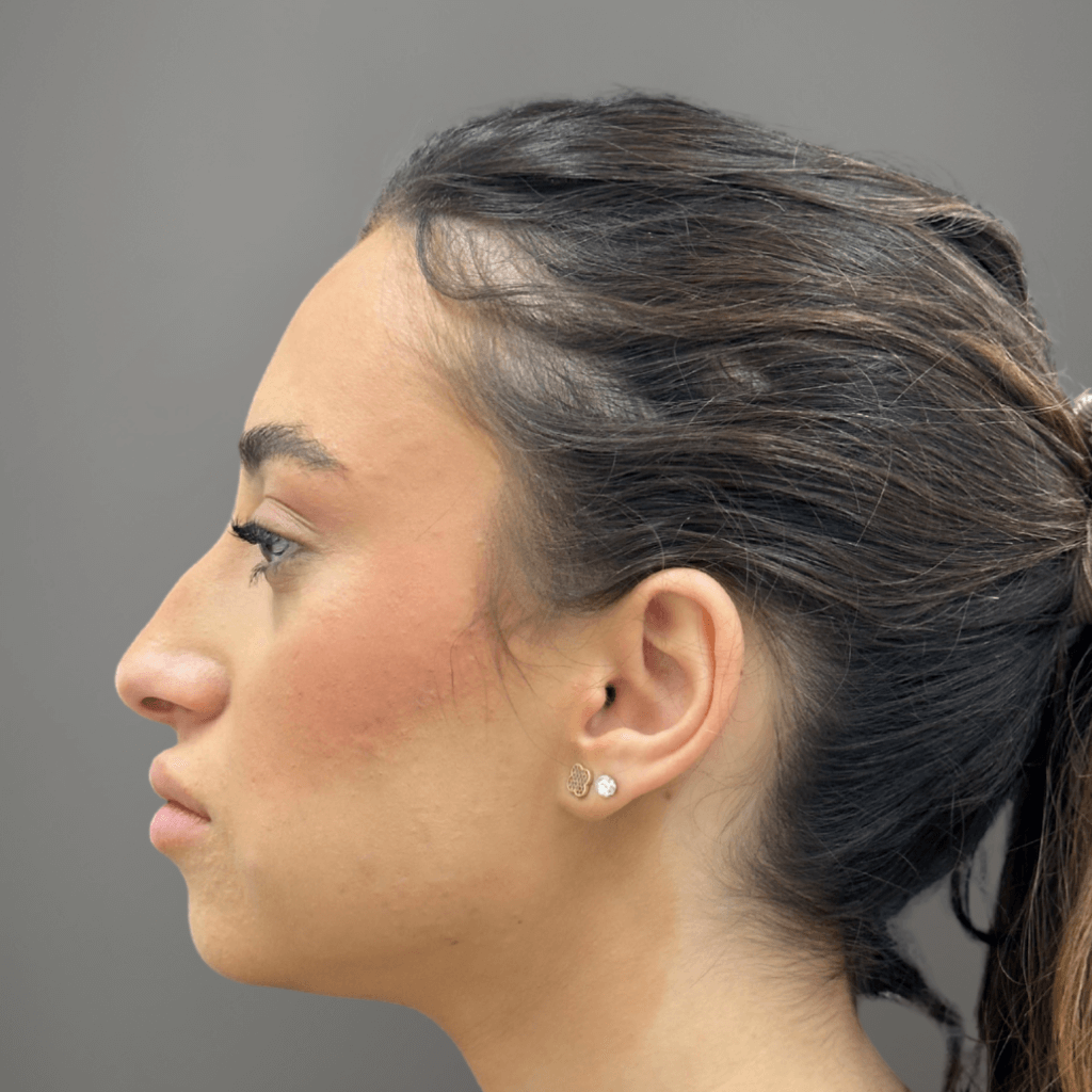 Профилен изглед на лице преди ринопластика, с изразен носен профил и нехармонични пропорции.