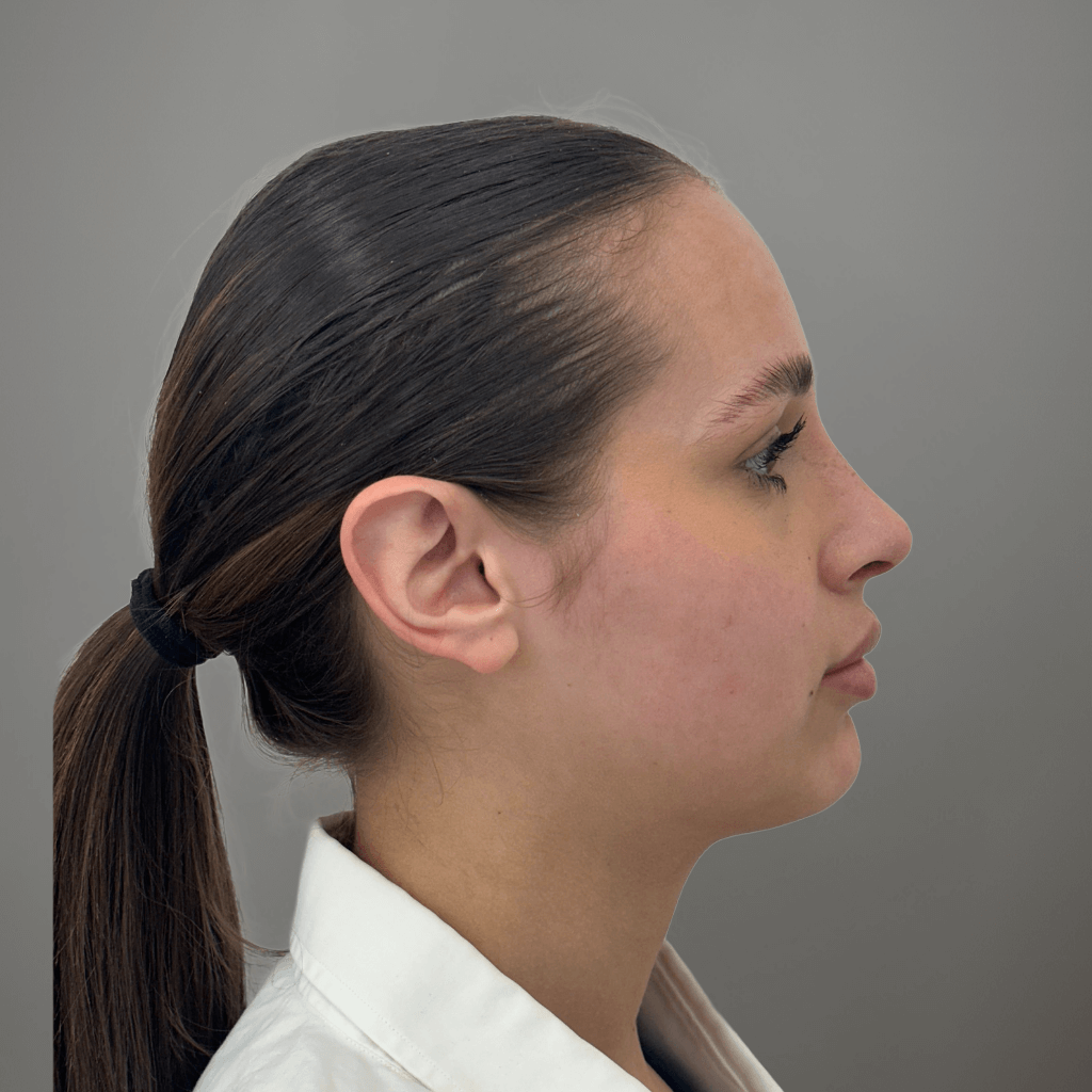 Профилен изглед на лице след ринопластика, с изгладен носен контур и естествена линия.