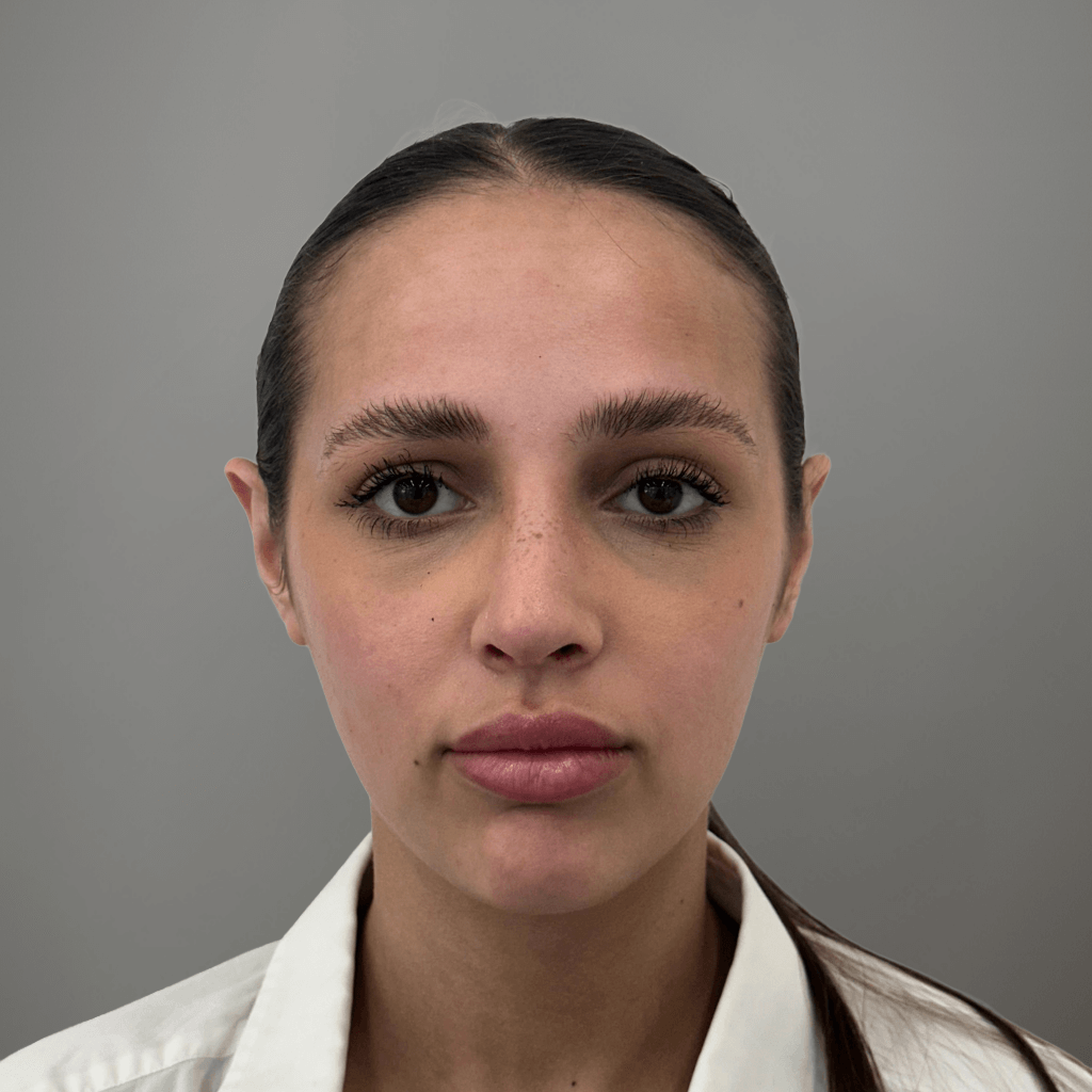 Фронтален изглед на лице след ринопластика, с подобрена симетрия и хармонична форма на носа.