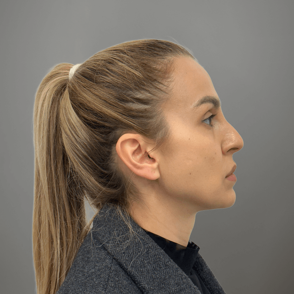 Профилна снимка отдясно на пациент преди ринопластика в клиника Aesthetico