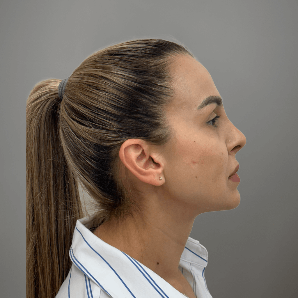 Профилен изглед на лице след ринопластика, с коригиран носен контур и по-хармонични лицеви пропорции.