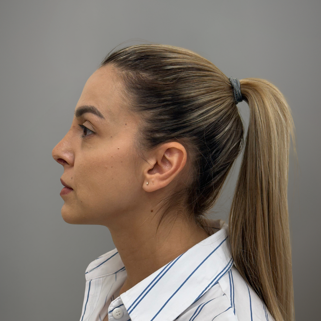 Профилен изглед на лице след ринопластика, с коригиран носен контур и по-хармонични лицеви пропорции.