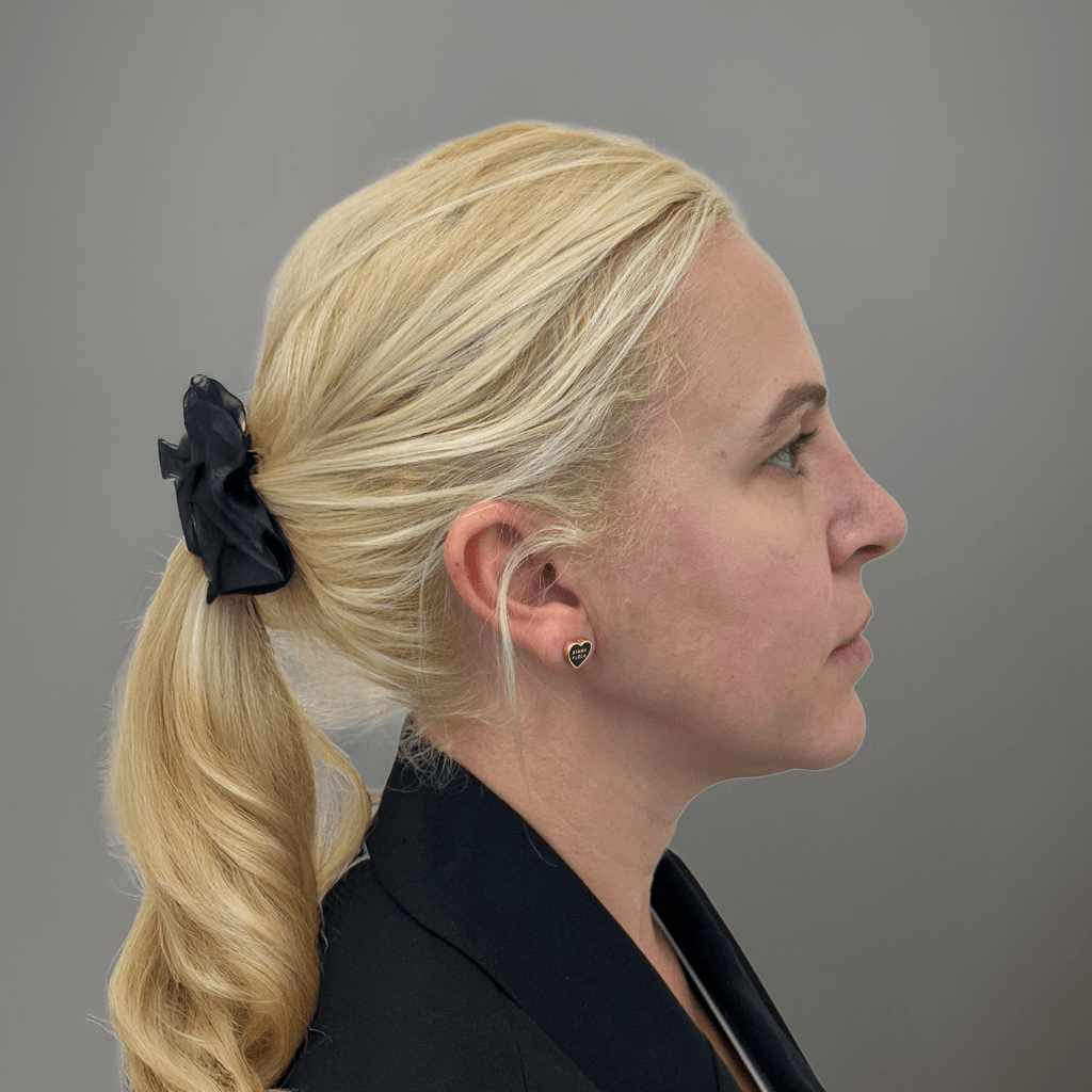 Профилна снимка отдясно на пациент след естетична лицева интервенция, показваща естествено подобрение в контурите и пропорциите, извършена в клиника Aesthetico