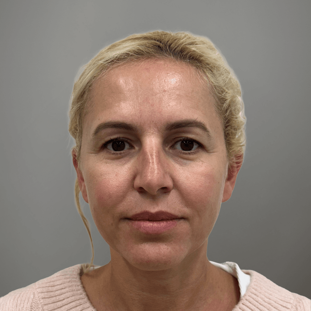 Фронтален изглед на лице преди ринопластика, с изразен гръб на носа и нарушен профилен баланс.