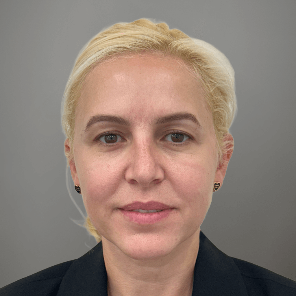 Фронтален изглед на лице след ринопластика, с изгладена линия на носа и естествен профилен резултат.