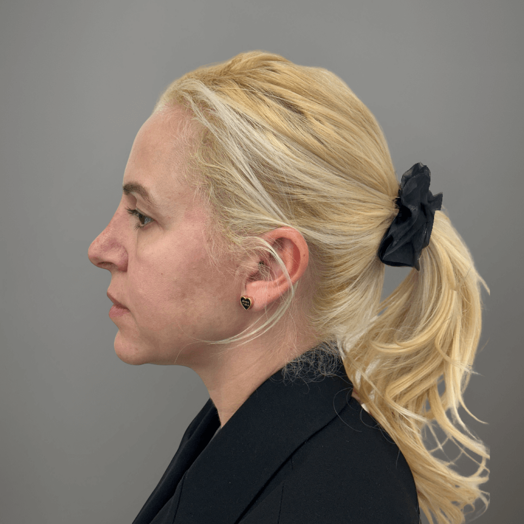 Профилна снимка на пациент след естетична лицева процедура, с подобрена симетрия и контур на лицето, извършена в клиника Aesthetico