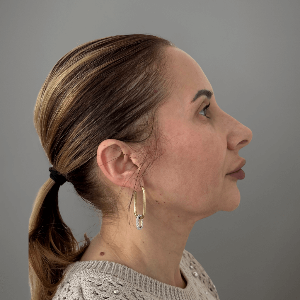 Профилен изглед на лице след ринопластика, с коригиран носен контур и естествен профилен резултат.