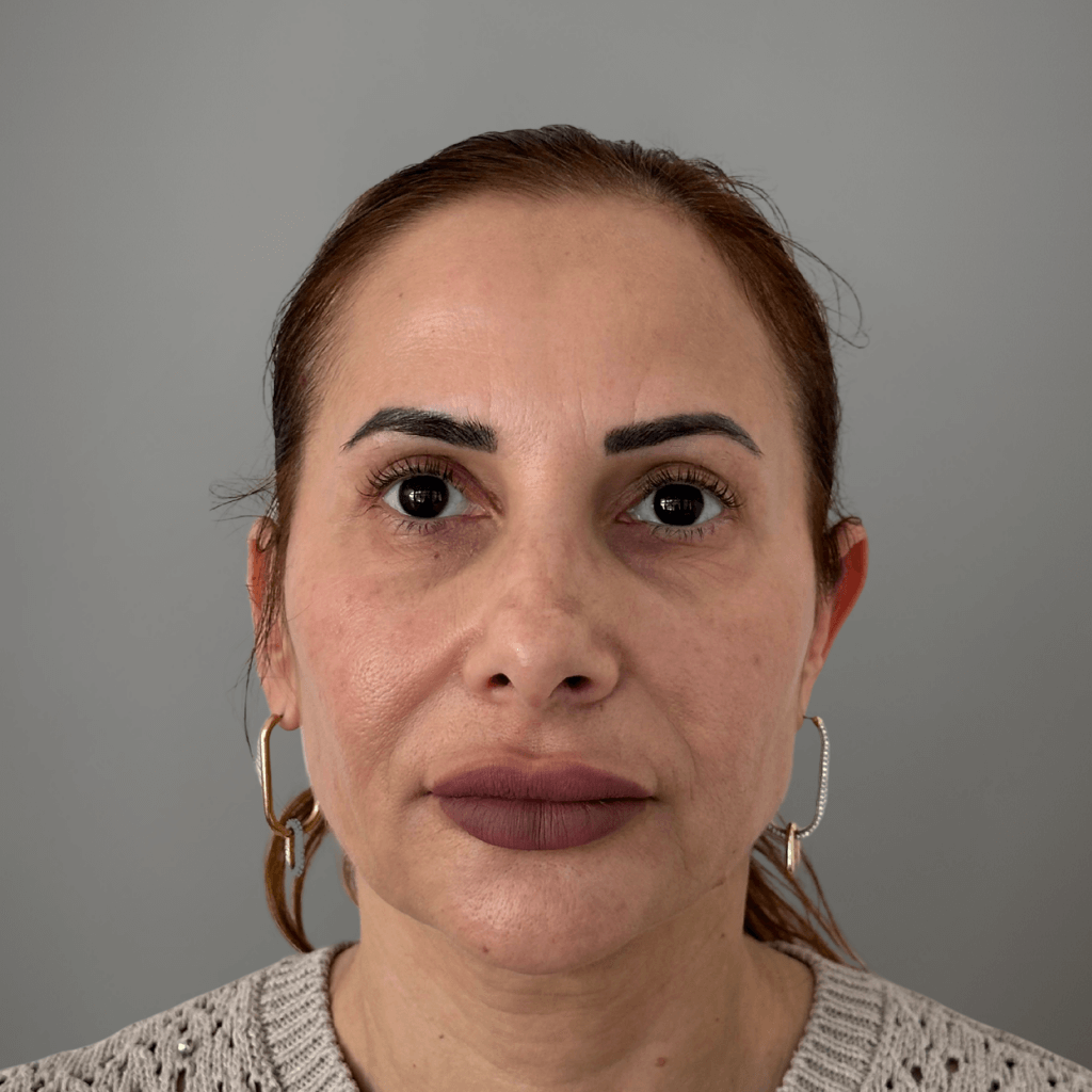 Фронтален изглед на лице преди ринопластика, с асиметрия и подчертана форма на носа.