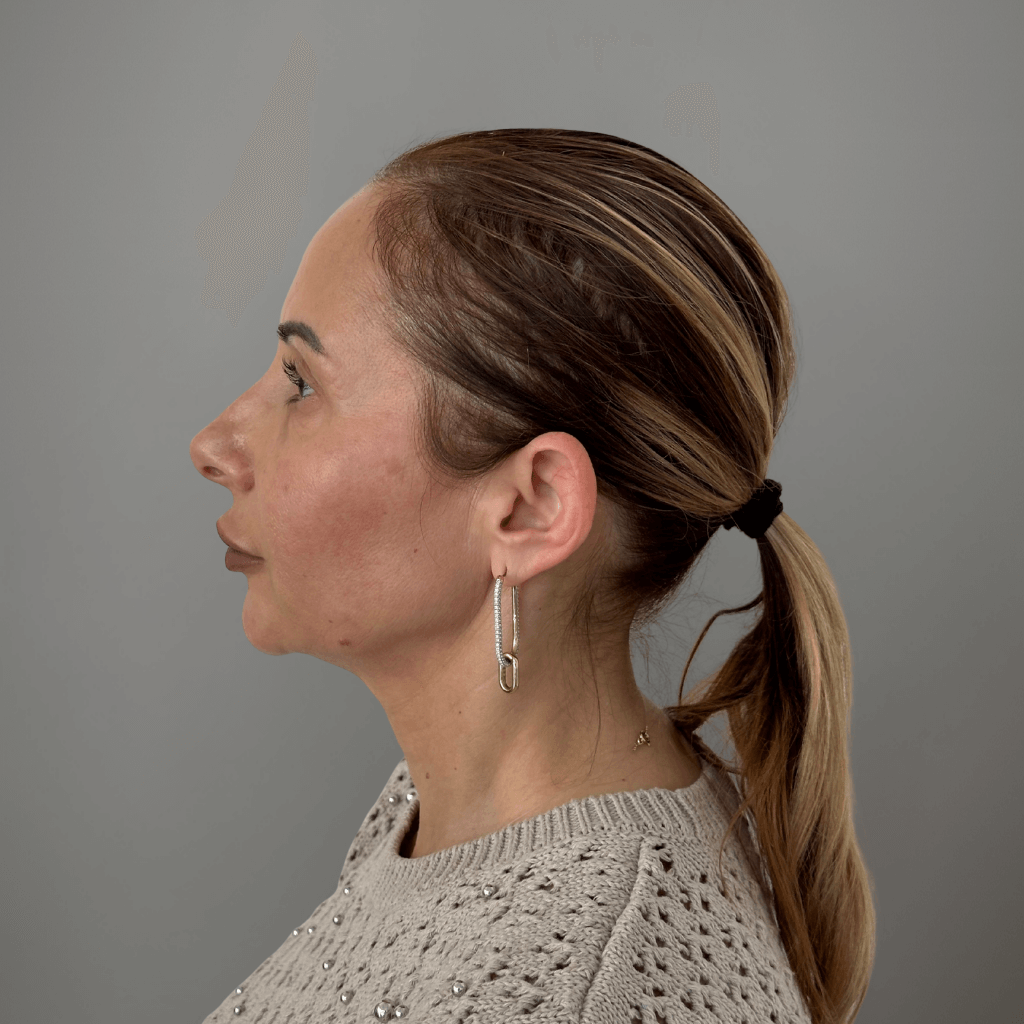 Профилна снимка отляво на пациент преди ринопластика в клиника Aesthetico