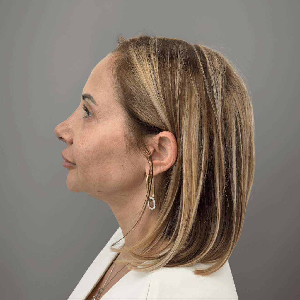 Профилна снимка отляво на пациент след ринопластика, показваща по-фин контур и естествена хармония на носа след процедура в клиника Aesthetico