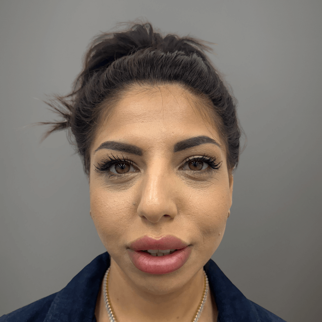 Фронтална снимка на пациент преди ринопластика, документираща естественото състояние на носа преди интервенцията в клиника Aesthetico