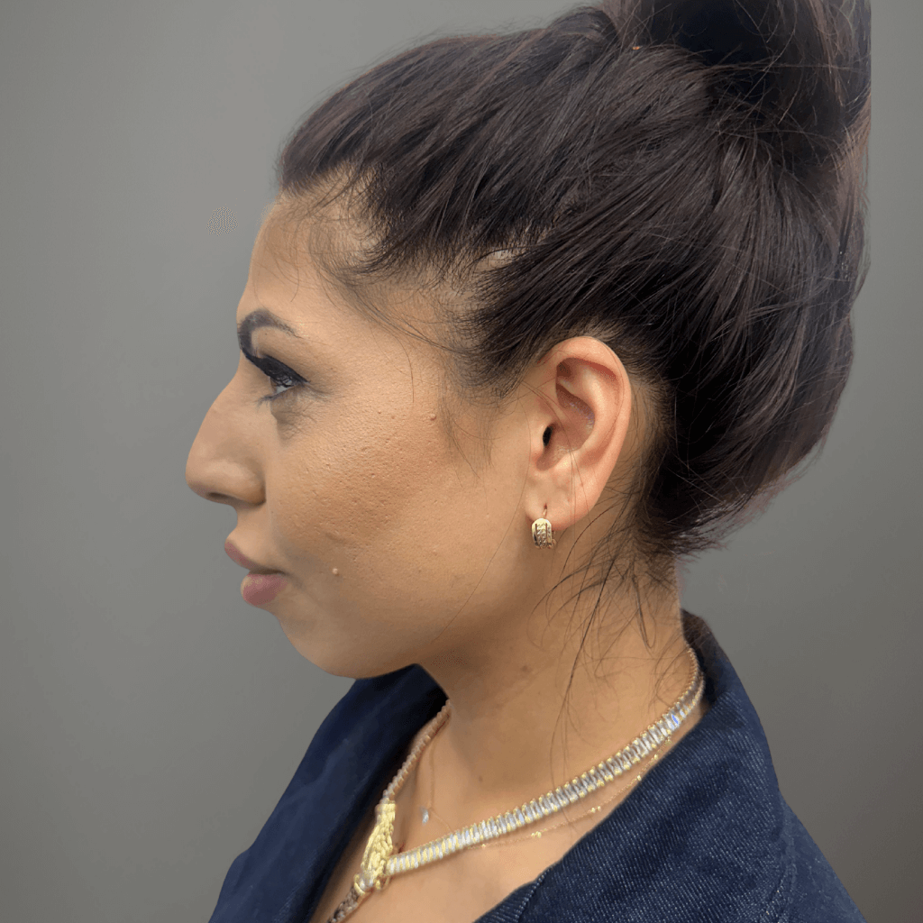 Профилен изглед на лице преди ринопластика, с изразен носен профил.