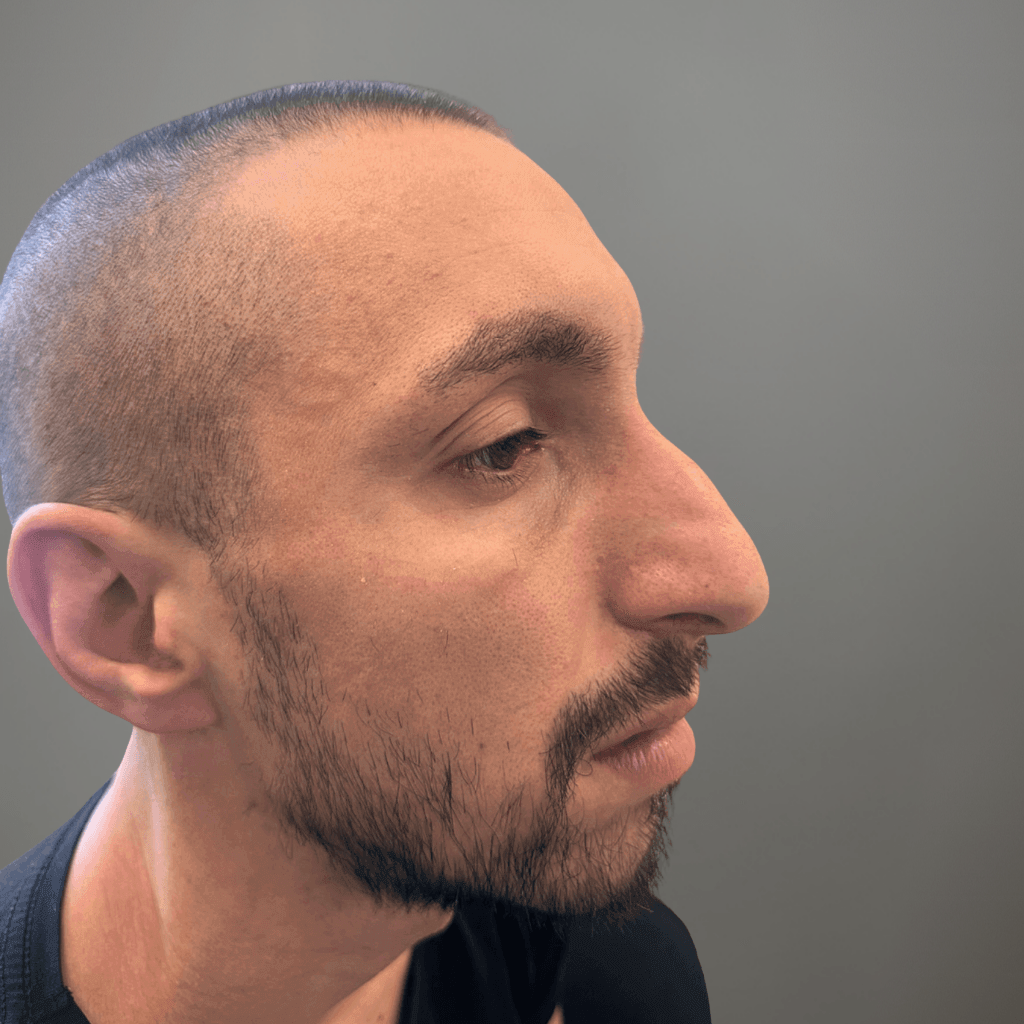 Профилна снимка отдясно на пациент преди ринопластика, показваща първоначалния носов контур преди операция в клиника Aesthetico