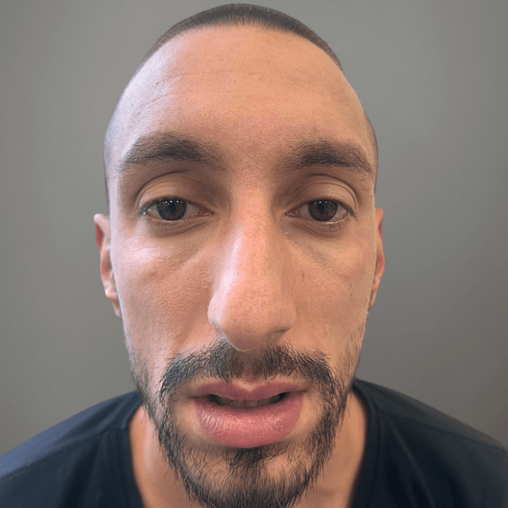 Фронтален изглед на лице преди ринопластика, с подчертана форма на носа и асиметрия.