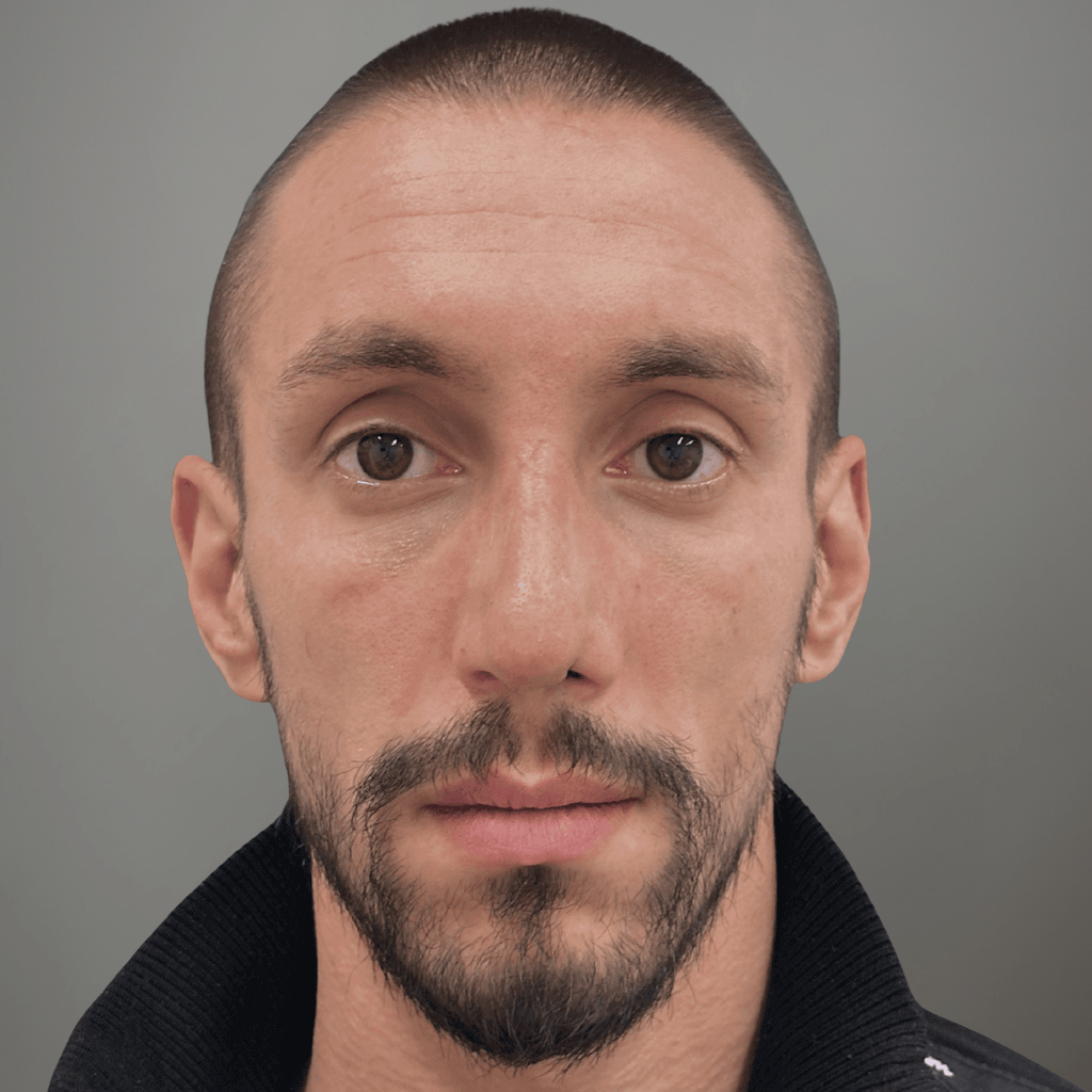 Фронтална снимка на пациент след ринопластика, показваща подобрена симетрия и естествен резултат след процедура в клиника Aesthetico