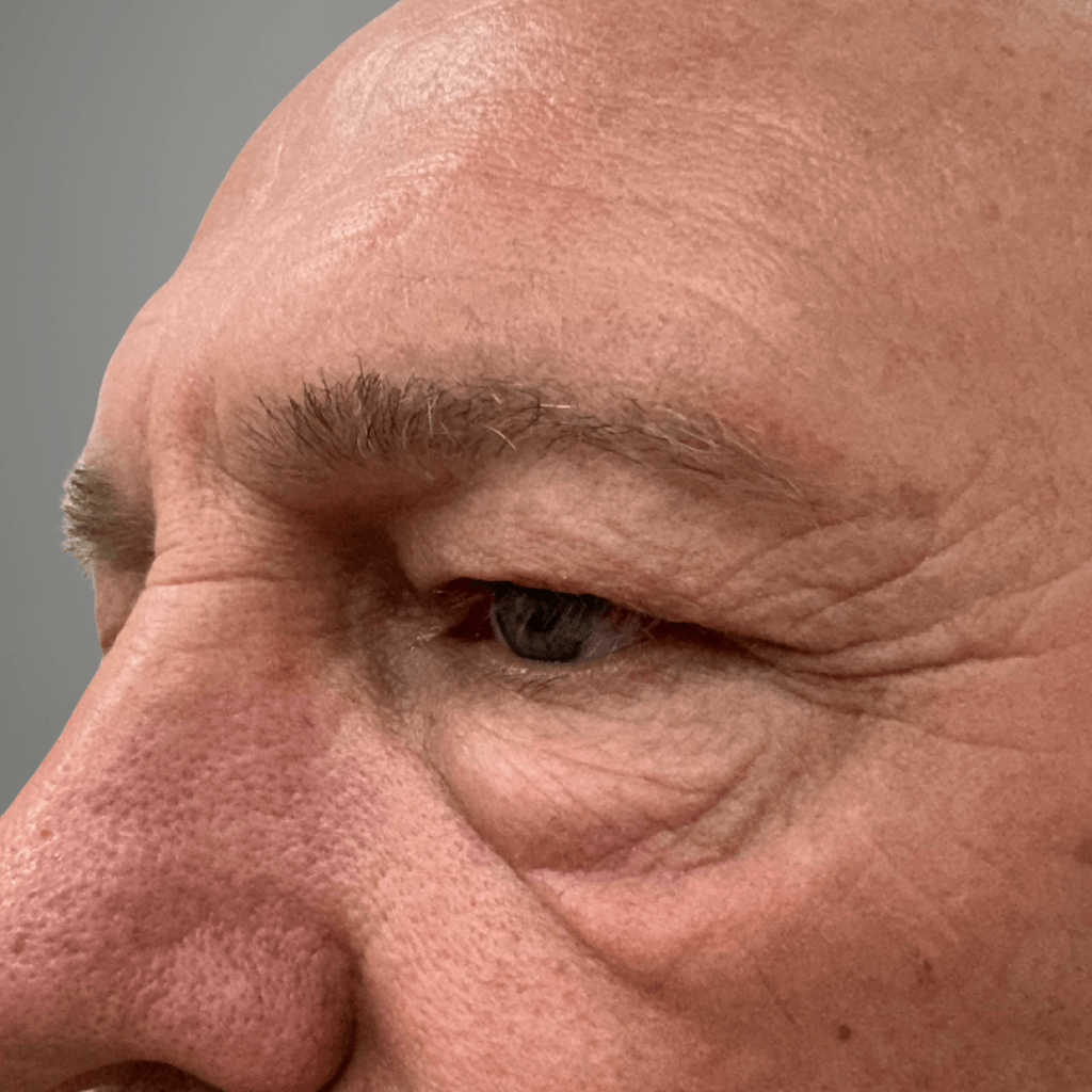 Мъж в зряла възраст преди горна блефаропластика – видими отпуснати клепачи и фини бръчки около очите