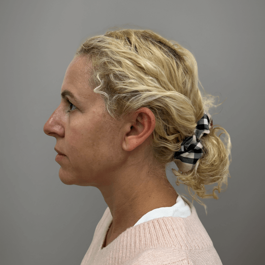 Профилна снимка на пациент преди естетична лицева процедура в клиника Aesthetico