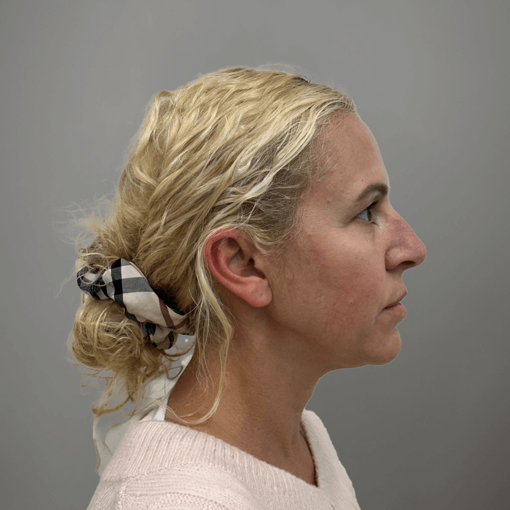 Профилна снимка отдясно на пациент преди естетична лицева интервенция в клиника Aesthetico