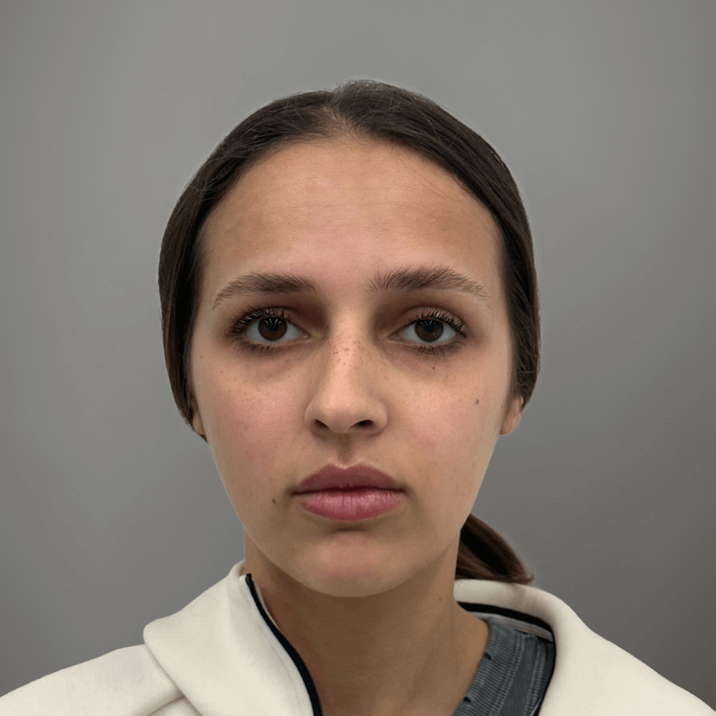 Фронтална снимка на пациент преди ринопластика, показваща естественото състояние на носа преди корекция в клиника Aesthetico