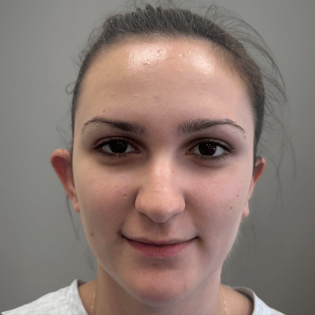 Пациент преди отопластика – фронтален изглед, видимо изразено отстояние на ушите