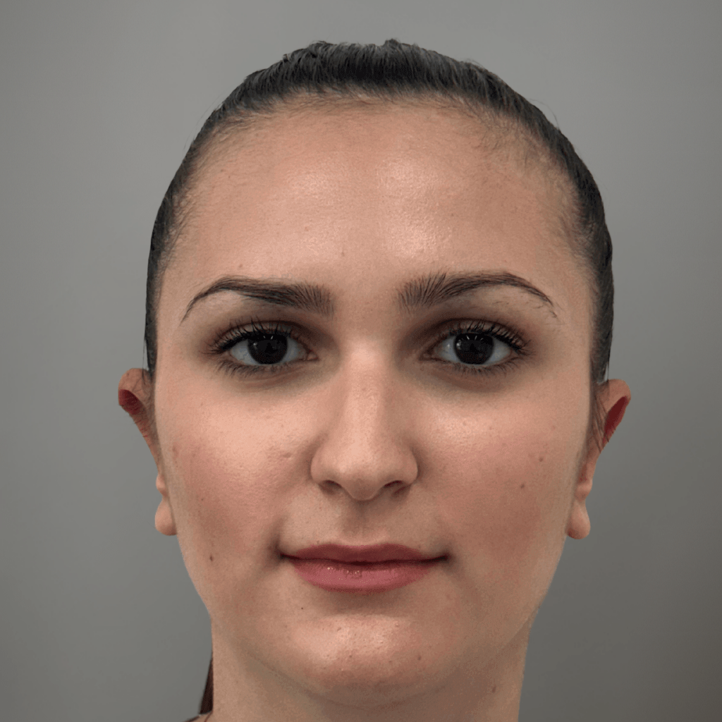 Пациент след отопластика – фронтален изглед, естествена симетрия и прибрани уши