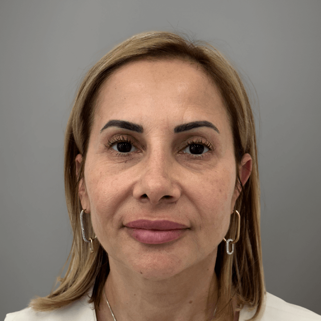 Фронтална снимка на пациент след ринопластика, демонстрираща освежен и естествен резултат след лечение в клиника Aesthetico