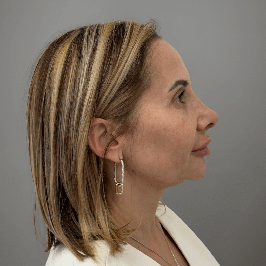 Профилна снимка отдясно на пациент след ринопластика, показваща подобрен носов профил и балансирани пропорции, постигнати в клиника Aesthetico