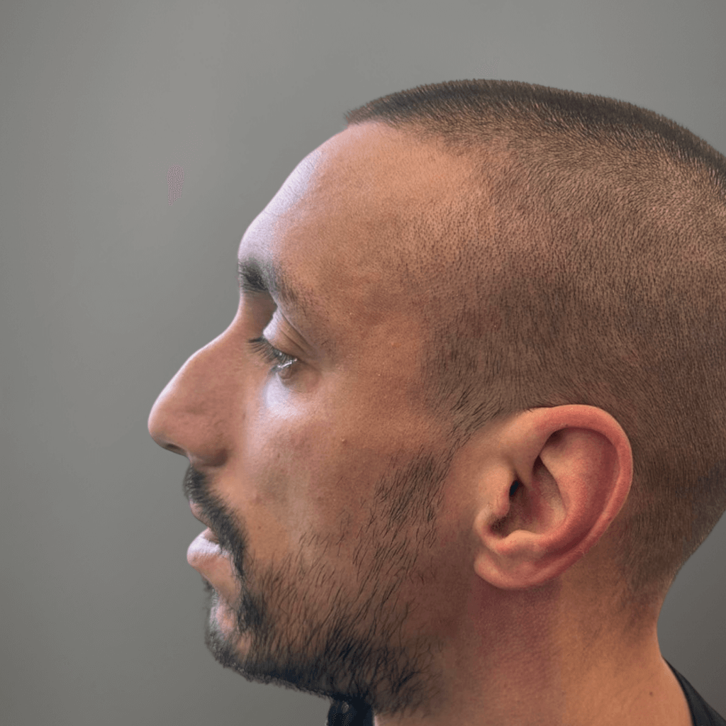 Профилна снимка отляво на пациент преди ринопластика, показваща изразен носов гръб и профил преди корекция в клиника Aesthetico