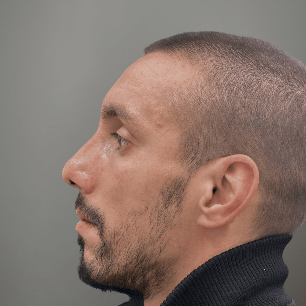 Профилна снимка отляво на пациент след ринопластика, демонстрираща изправен носов контур и по-балансиран профил, постигнат в клиника Aesthetico