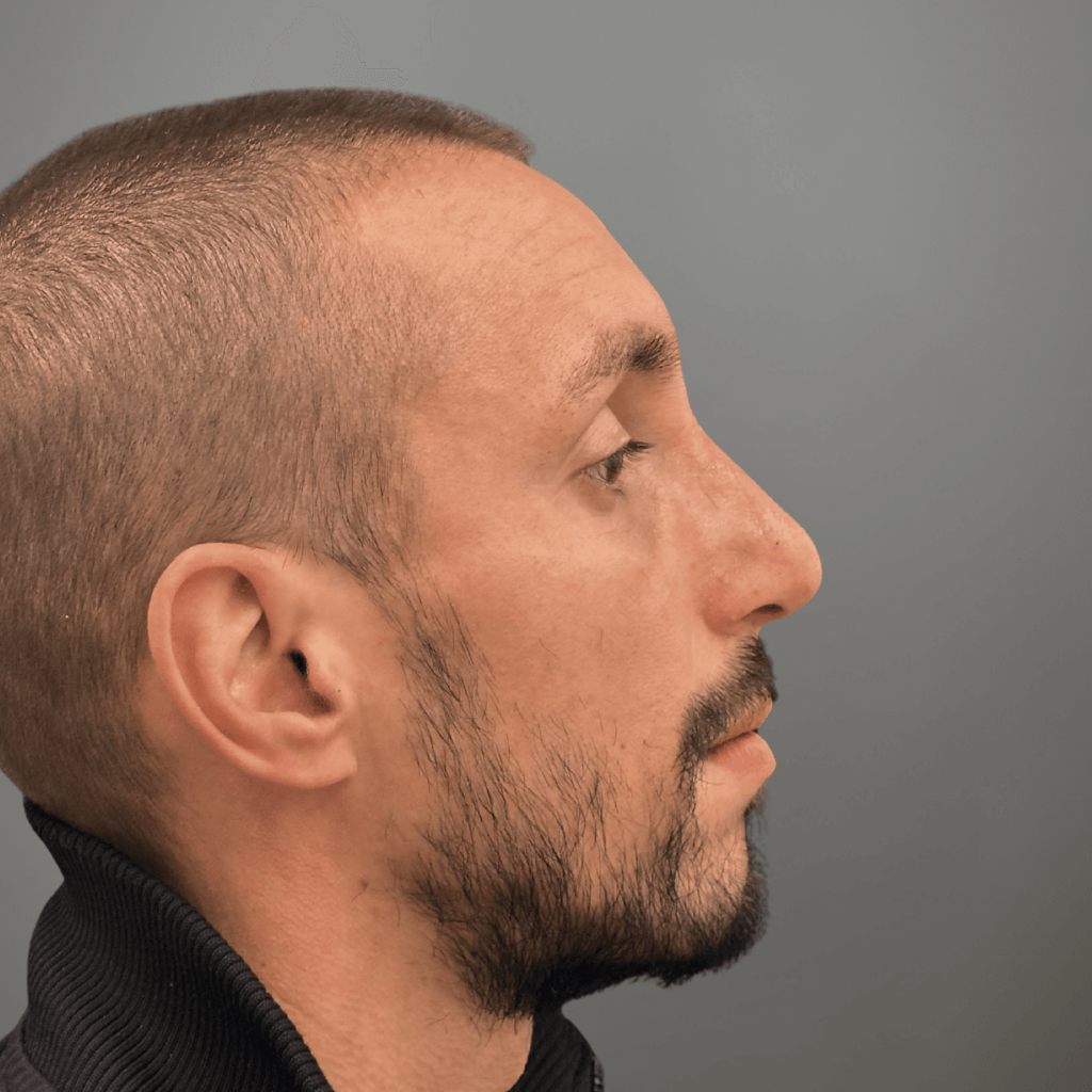 Профилна снимка отдясно на пациент след ринопластика, демонстрираща изгладен профил и естествен резултат, постигнат в клиника Aesthetico