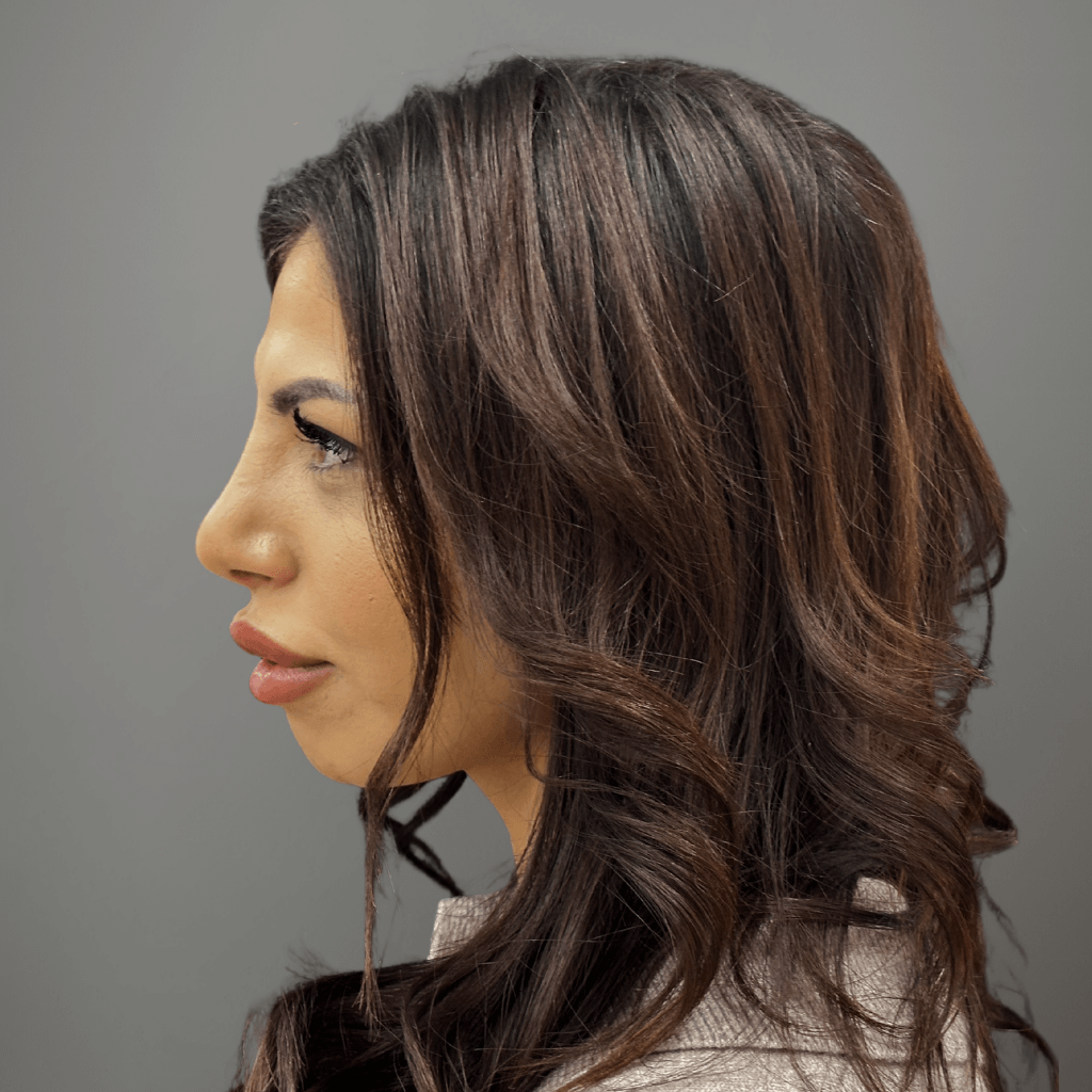 Профилна снимка отляво на пациент след ринопластика, демонстрираща изтънчен и хармоничен носов контур, постигнат в клиника Aesthetico