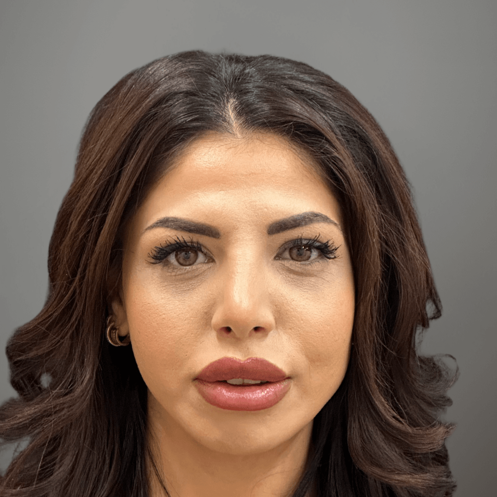 Фронтална снимка на пациент след ринопластика, показваща подобрена симетрия и естествен резултат след хирургична корекция в клиника Aesthetico