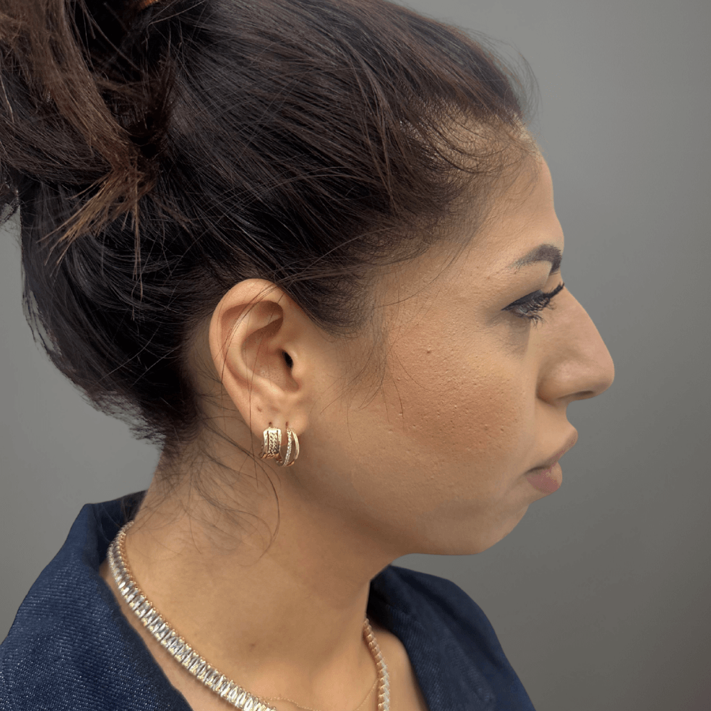 Профилна снимка отдясно на пациент преди ринопластика, показваща изразен носов гръб преди операция в клиника Aesthetico