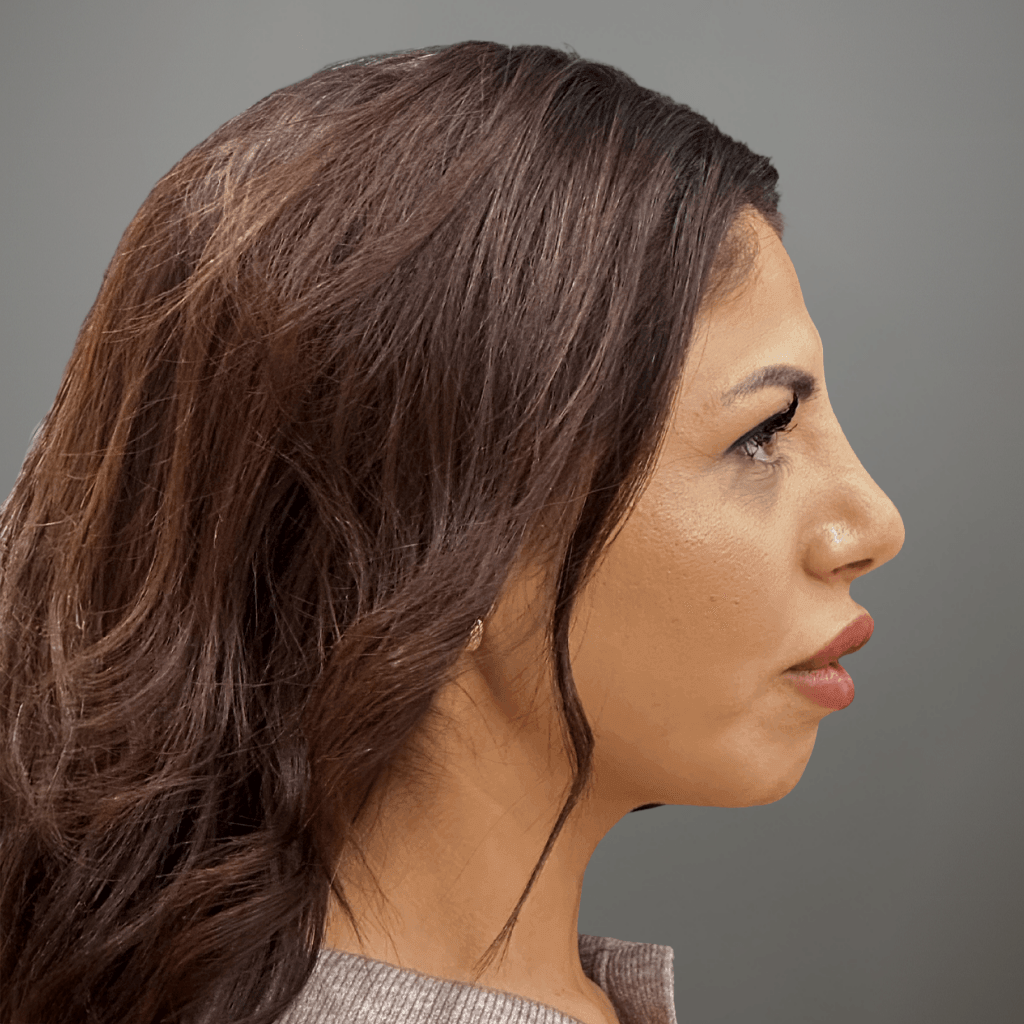 Профилна снимка отдясно на пациент след ринопластика, демонстрираща изправен профил и мек контур, постигнати в клиника Aesthetico