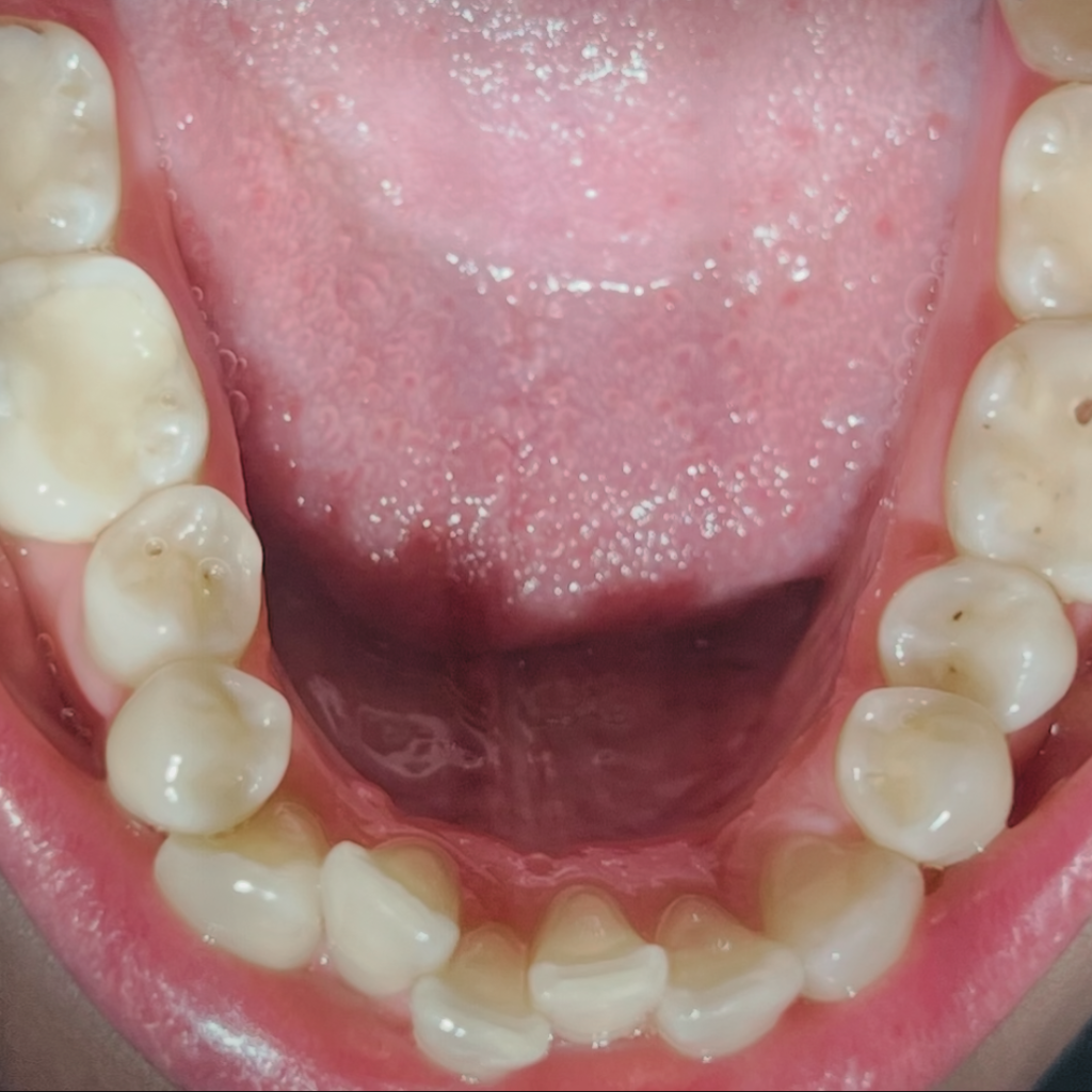 Долна челюст преди ортодонтско лечение с алайнери – струпани зъби и неправилно подреждане в предната зона.